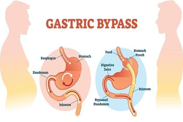 Gastric bypass surgery